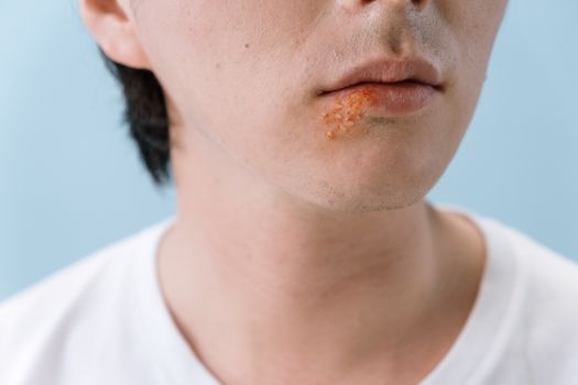 Cold Sores