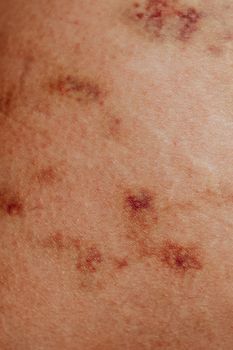 Contact Dermatitis