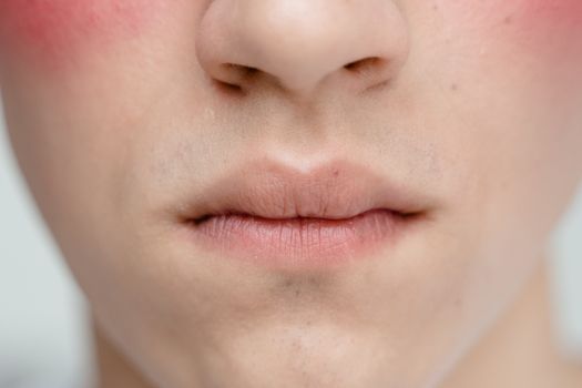 Broken Capillaries