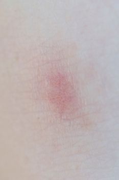 Skin Allergy