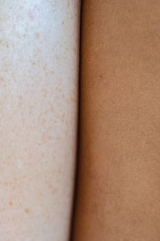 Keratosis Pilaris