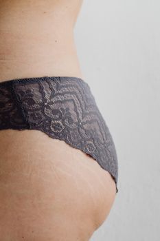 Stretch Marks
