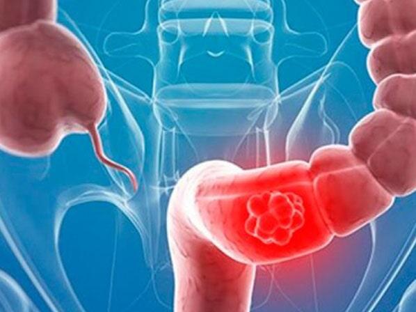 DR. JUAN MANUEL PADILLA ARRIAGA - Colonoscopia 