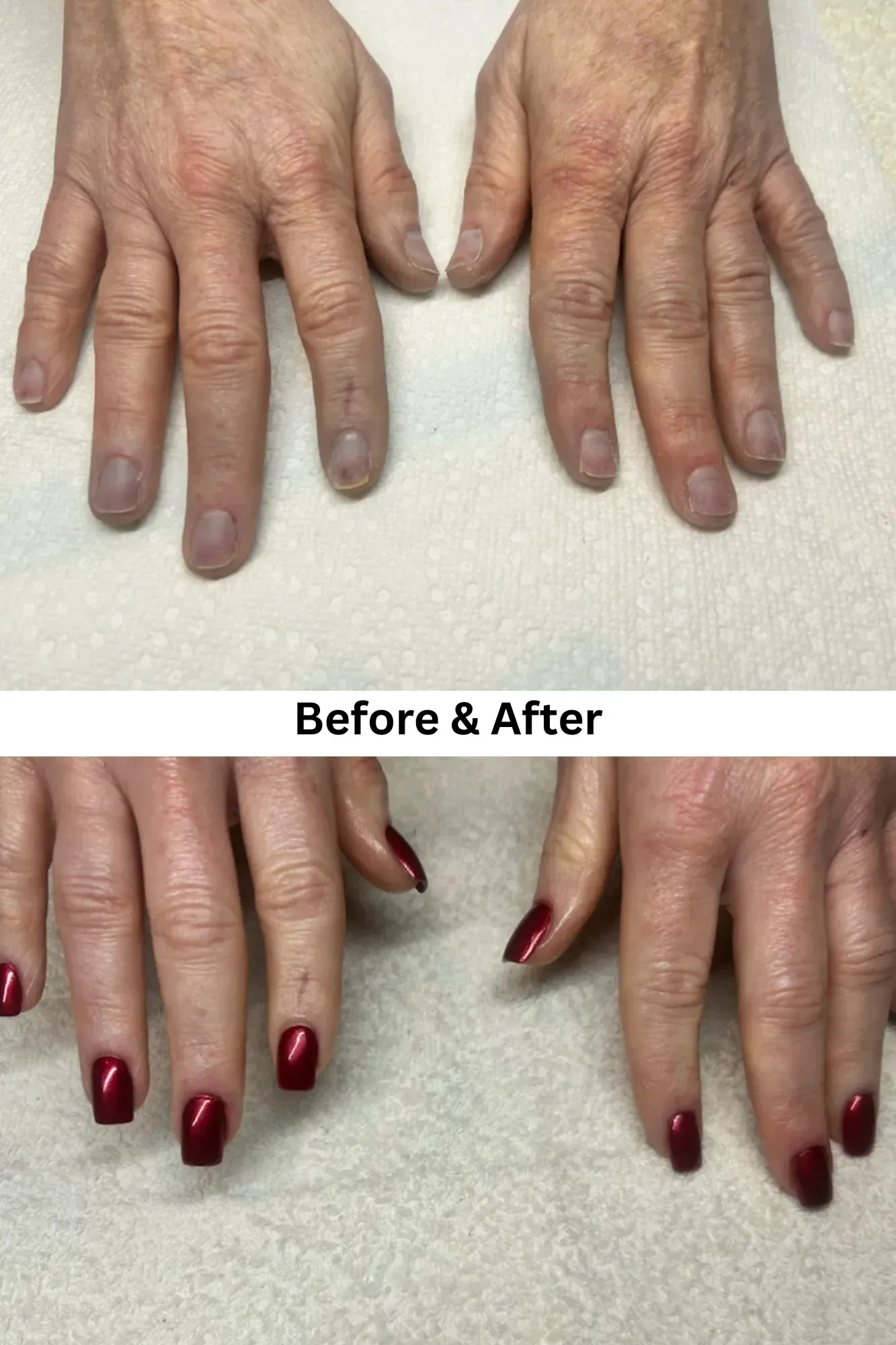 Before and After Acrylic Nail Restoration Before and After Acrylic Nail Restoration