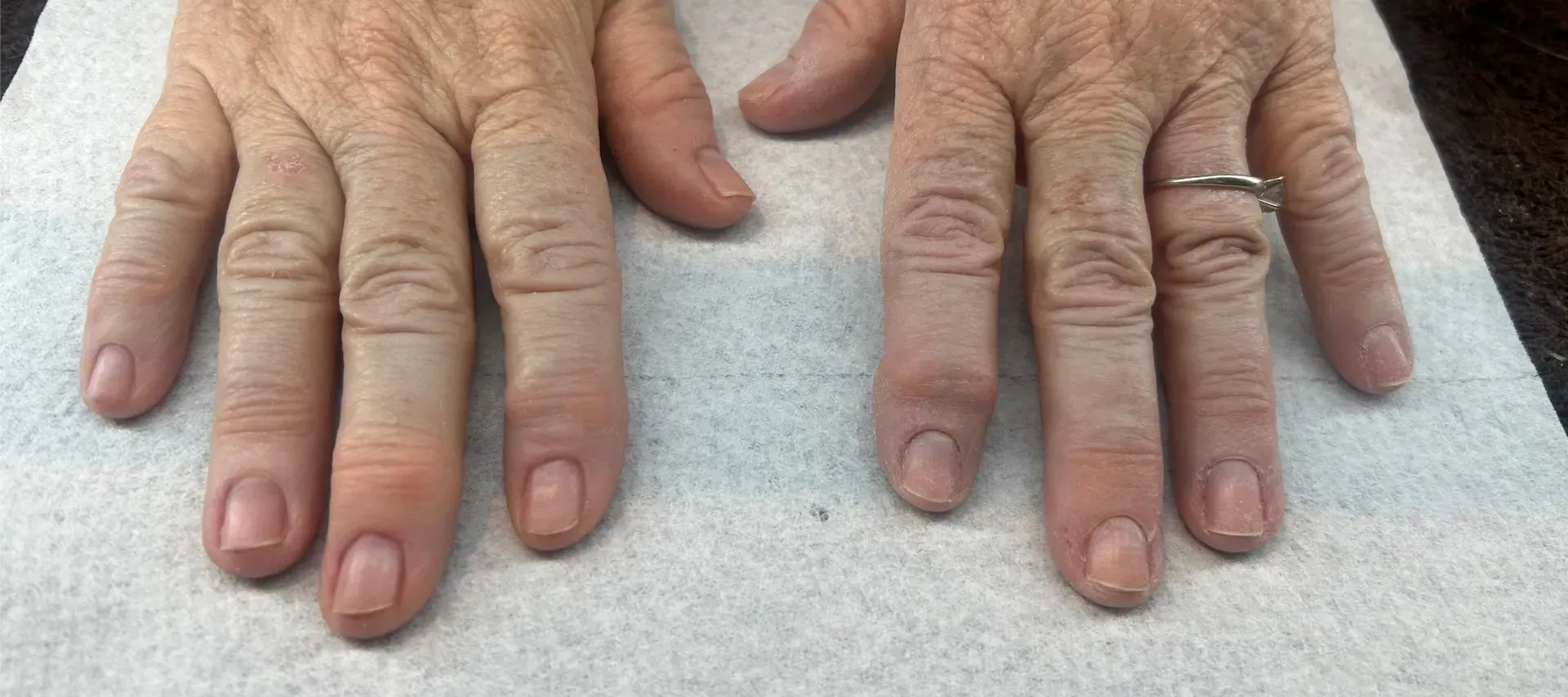Two hands with natural nails and one hand wears a ring. Two hands with natural nails and one hand wears a ring.