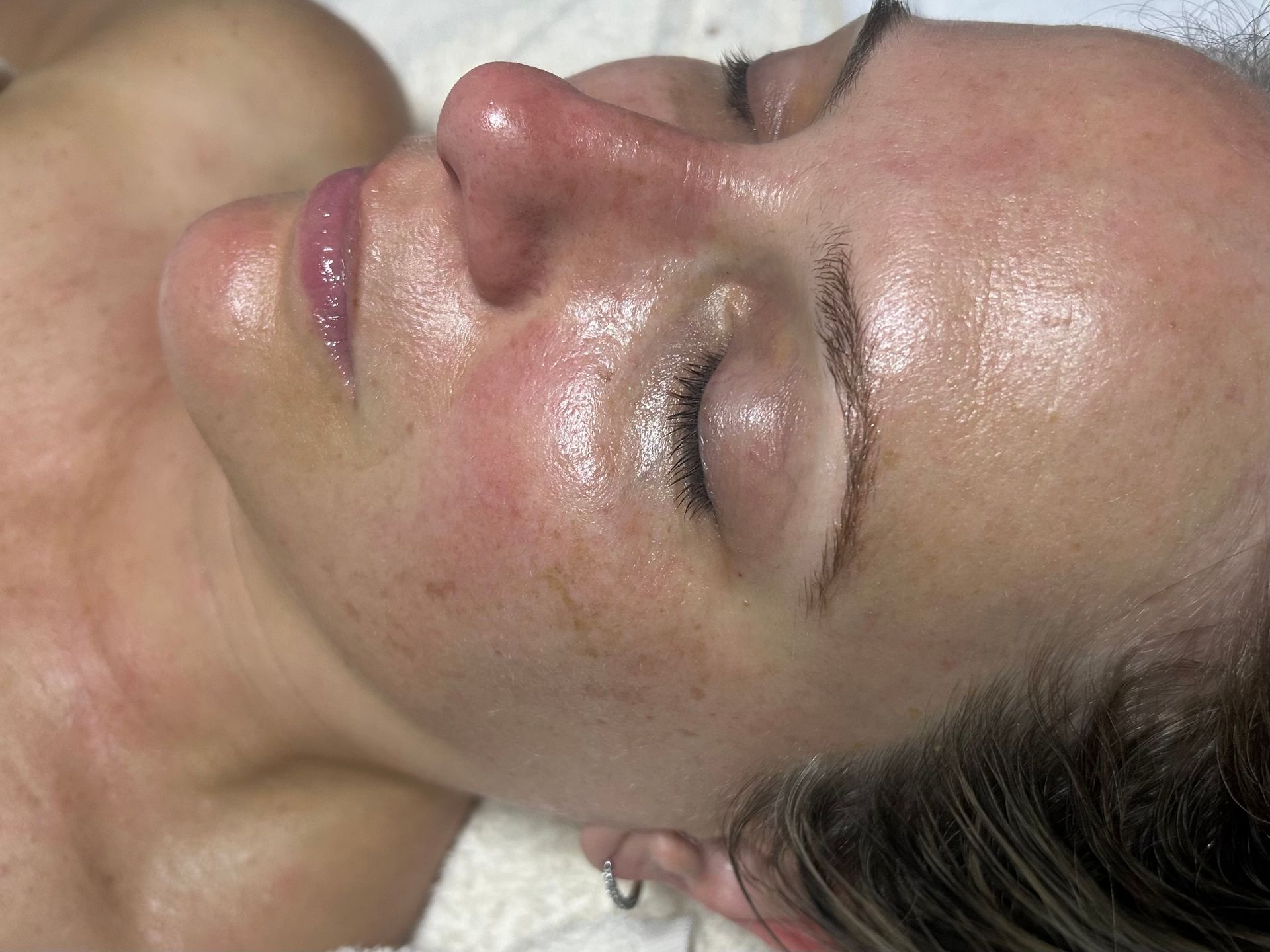 Antiaging Hydrafacial