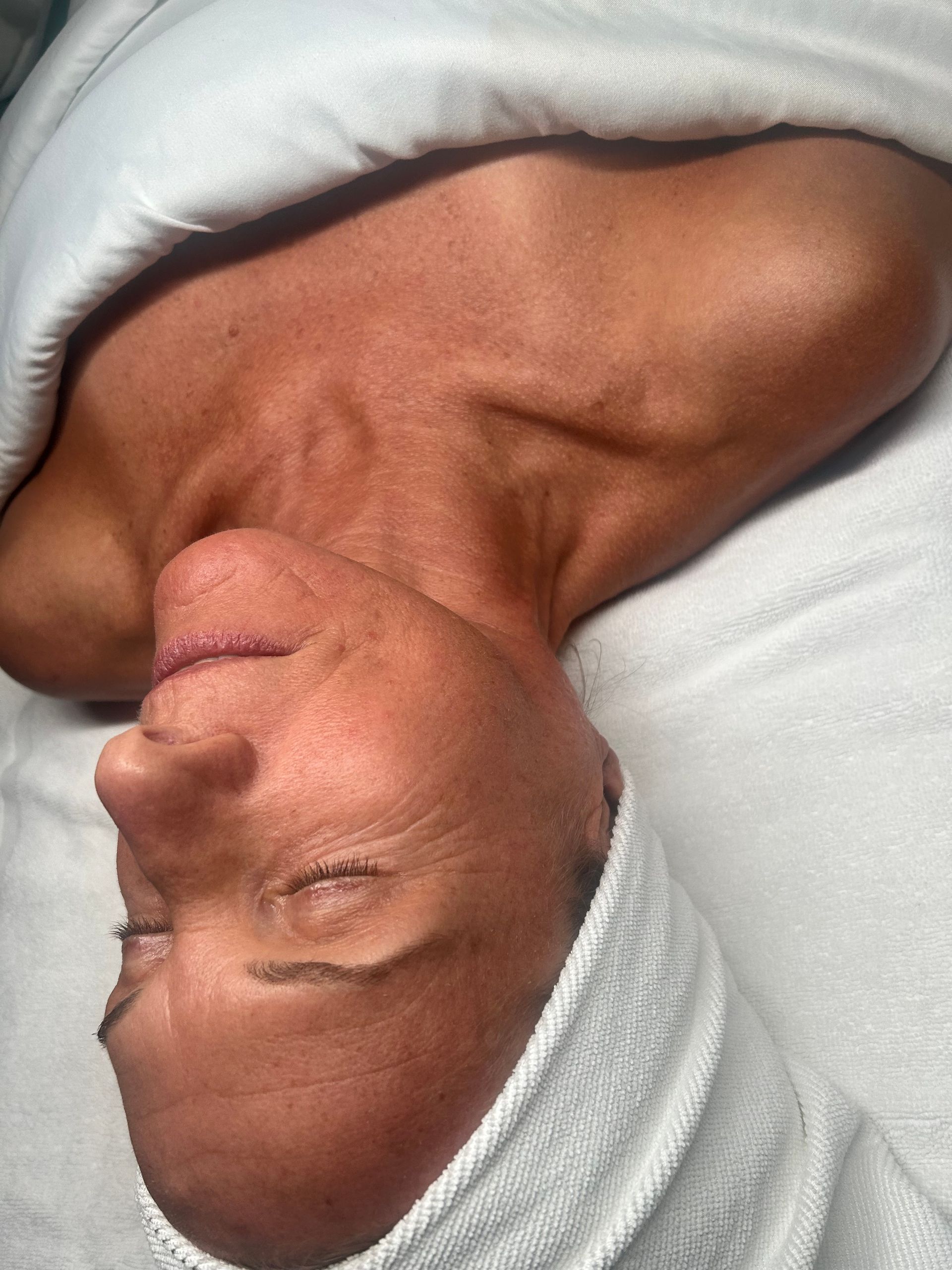 Before Platinum Hydrafacial with Dermaplaning