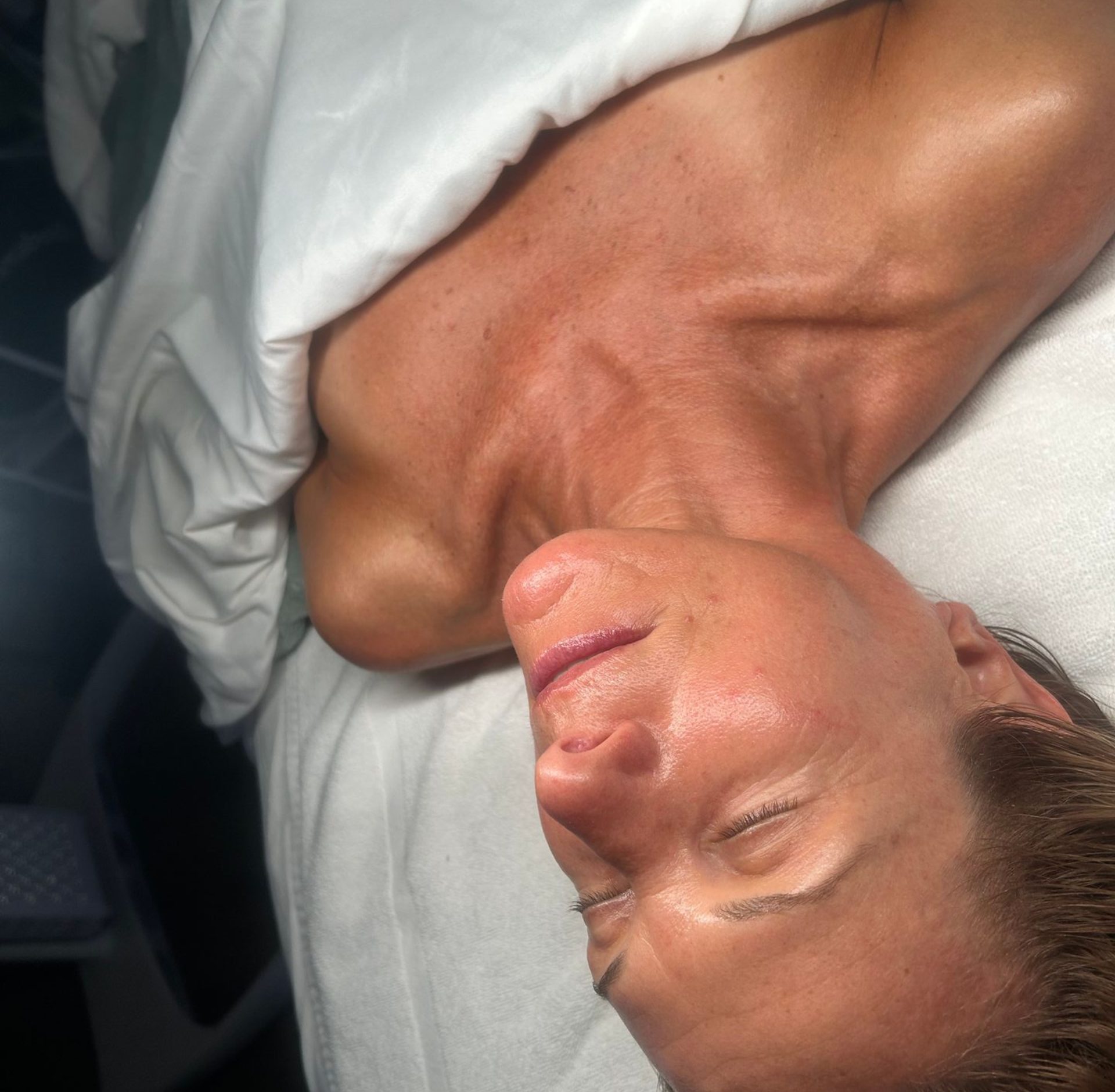 After 80 min Platinum Hydrafacial with Dermaplaning
