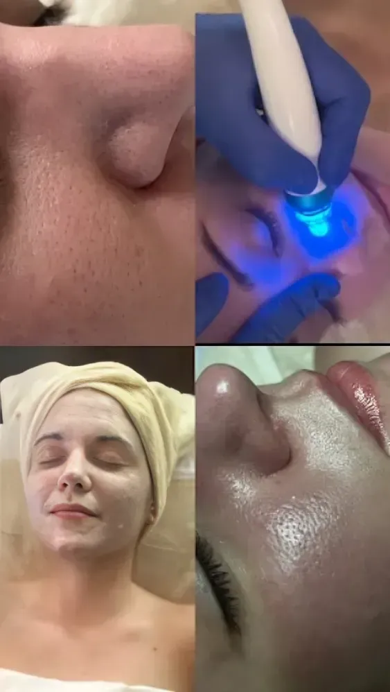 A collage showing a person receiving a facial treatment. A collage showing a person receiving a facial treatment.
