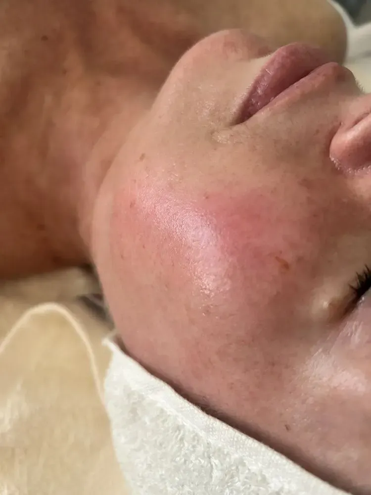 Close-up of a face preparing for a skin repair treatment in Tampa, FL.