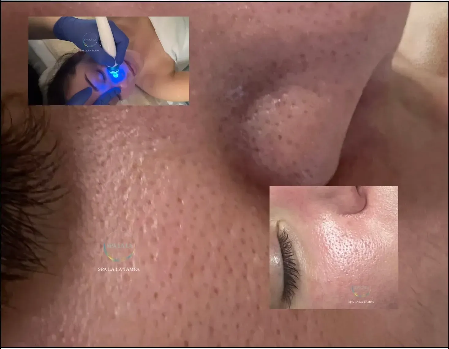 Before and after Hydra facial deep pore cleansing.