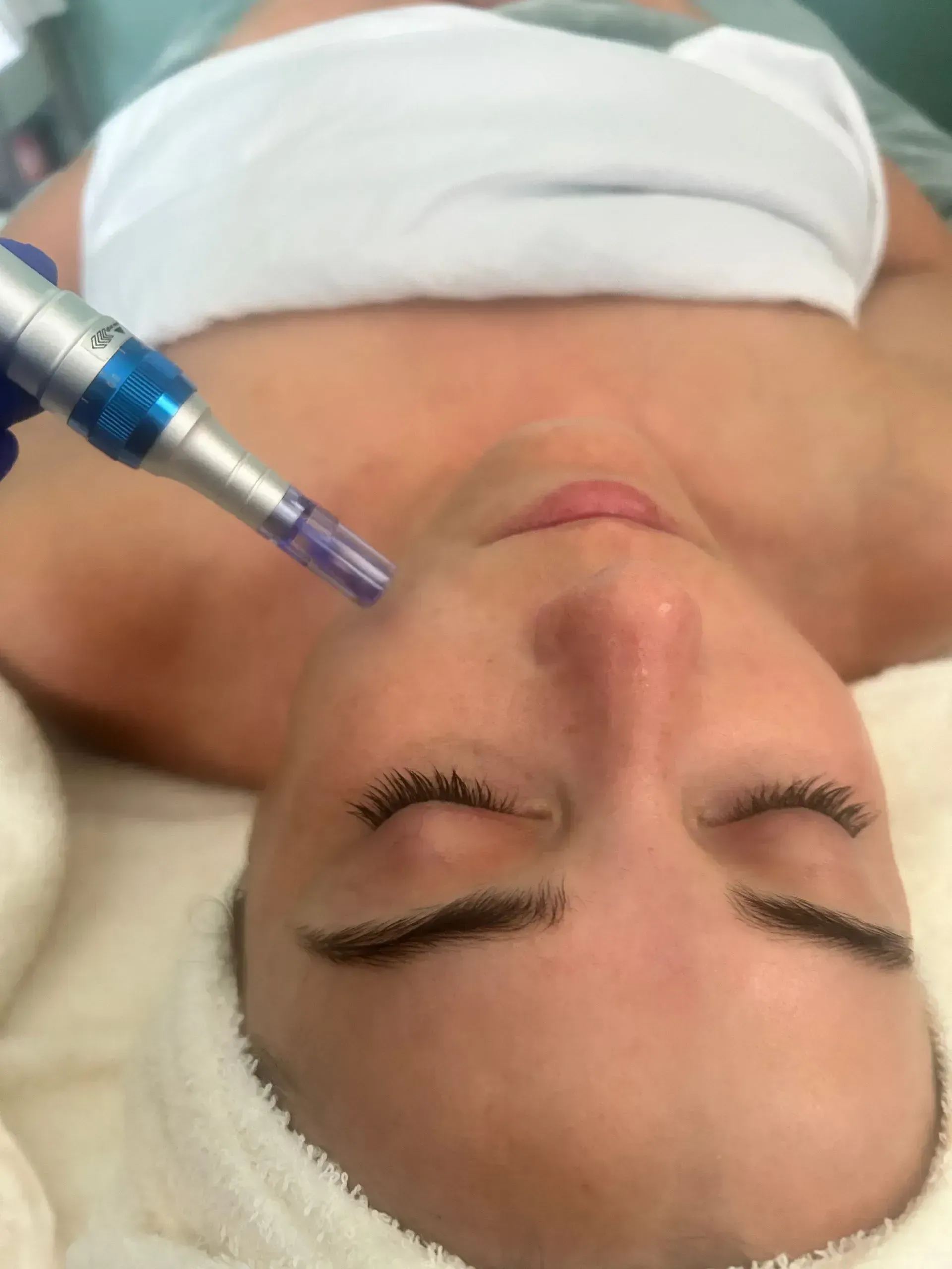 Woman receiving micro-needling facial treatment.
