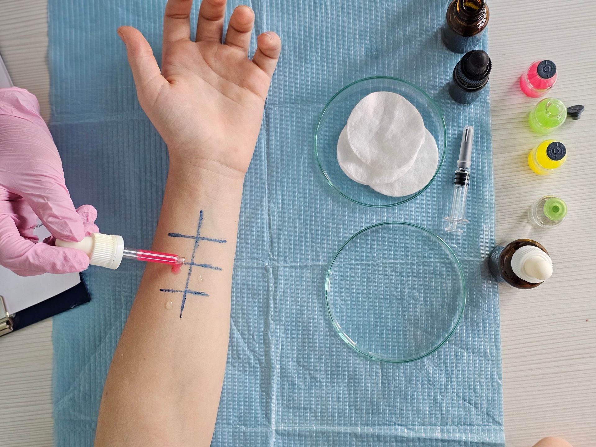 Allergist performing skin prick allergy test on patient forearm with allergen drops. Allergist performing skin prick allergy test on patient forearm with allergen drops.