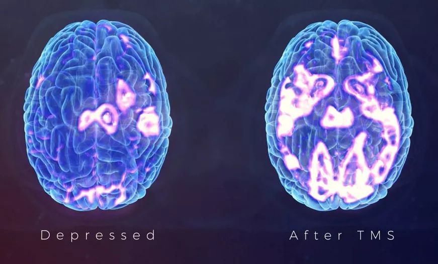 A picture of a brain before and after tms