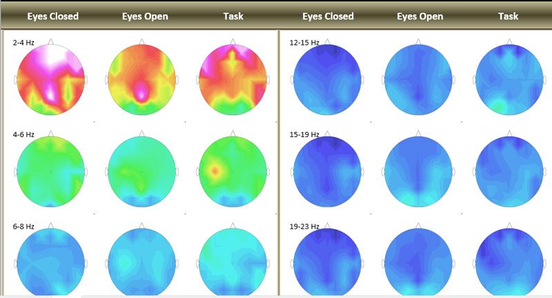 A bunch of circles with different colors showing an EEG mapping from TMS New Mexico