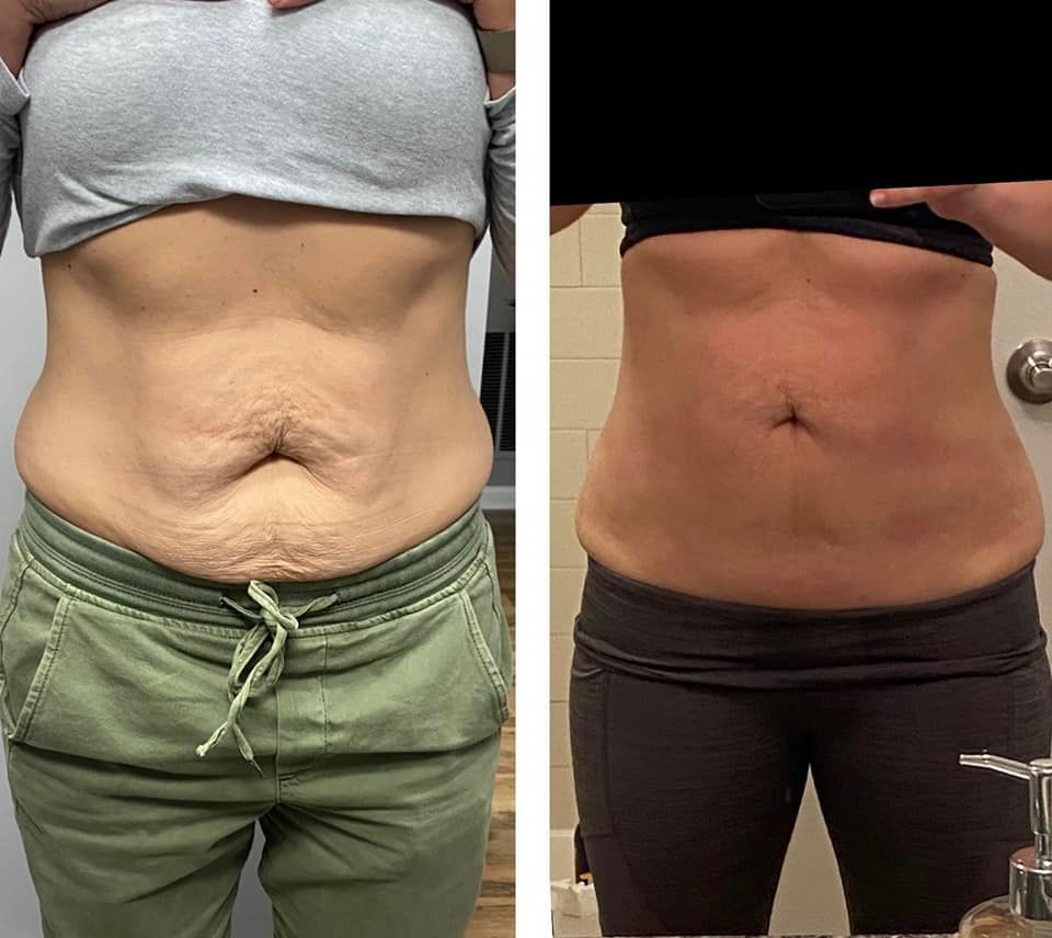 Side-by-side photos show a woman's abdomen before and after a body contouring treatment..