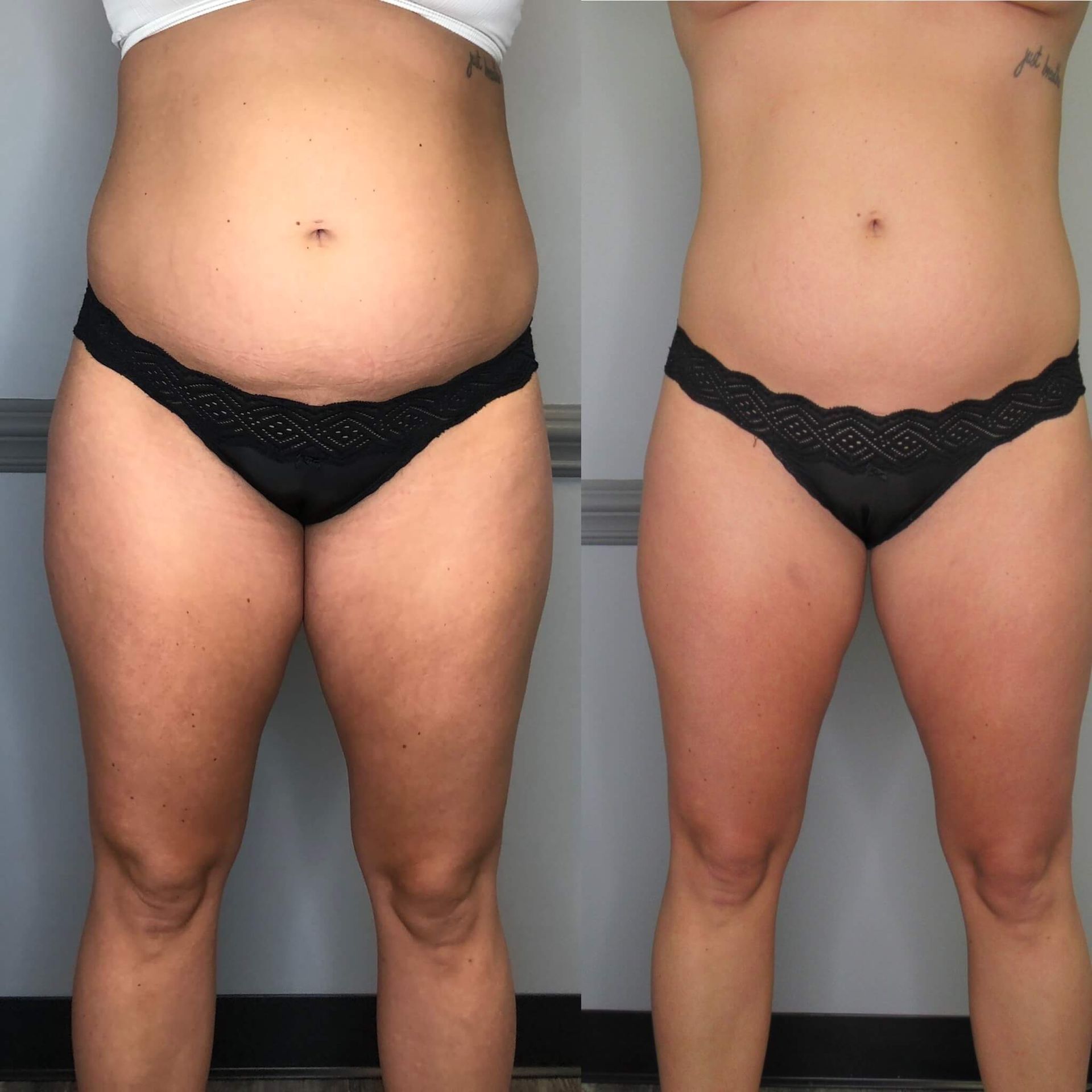 Before and after comparison of a woman's body. She has reduced fat on her abdomen and thighs.