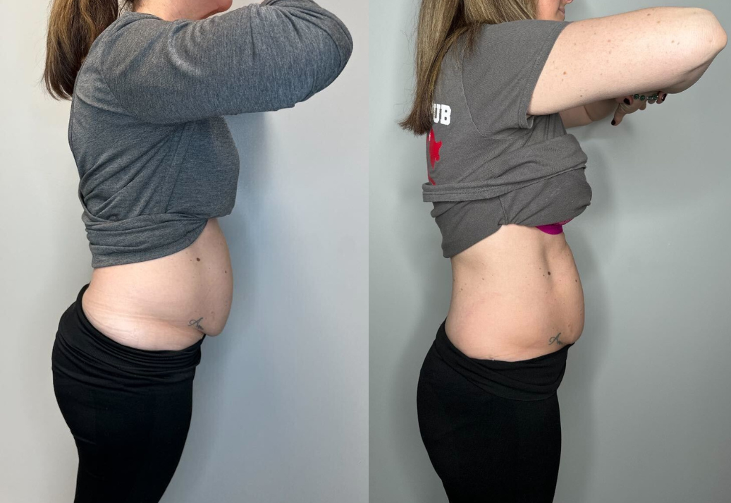Side-by-side abdominal before and after photos of a person with a post-surgery belly in a gray setting.