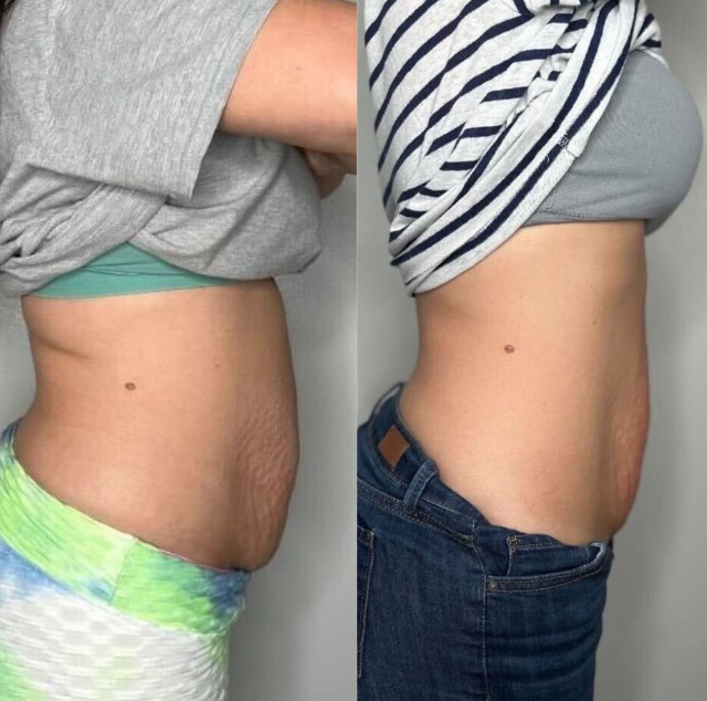 Side-by-side belly shots showing weight loss. Before: loose skin, tie-dye pants. After: slimmer waist, jeans.