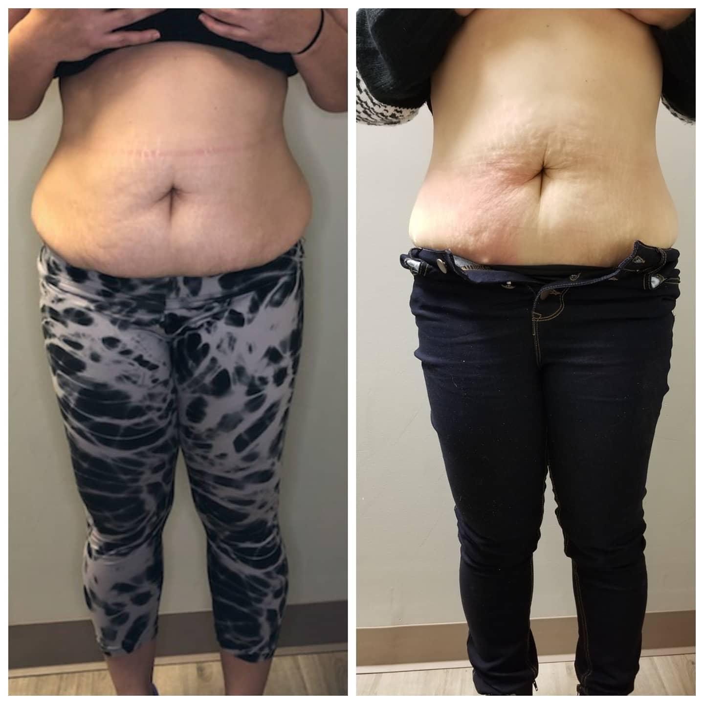 Before and after view of a woman's abdomen. Showing reduced fat after a procedure. She wears pants.