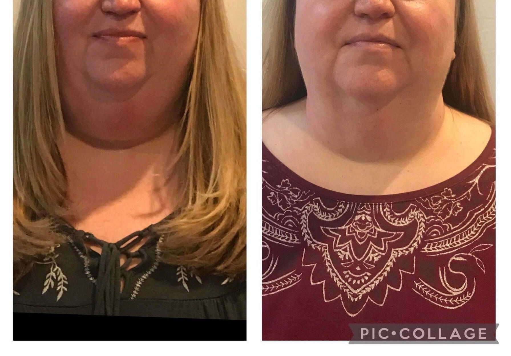 Side-by-side before and after photos of a woman's neck, showing a reduction in fullness after a treatment.