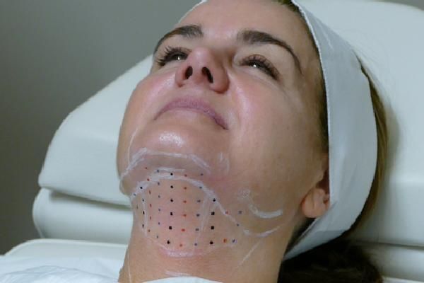 Woman with chin and neck marked for cosmetic procedure; dots outline the area.