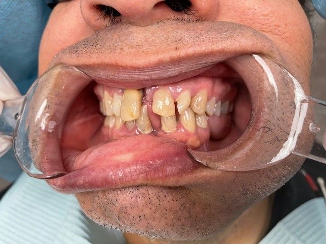 A close up of a person 's mouth with a mouth guard on it.