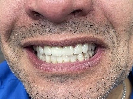 A close up of a man 's mouth with white teeth and a beard.