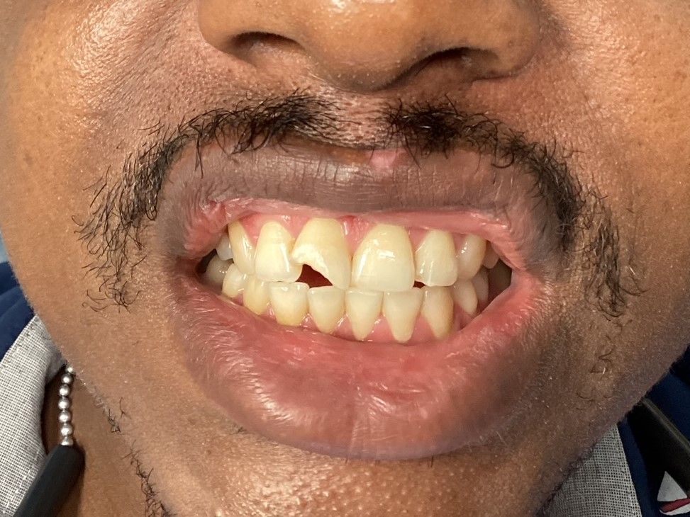 A close up of a man 's mouth with a beard and missing teeth.