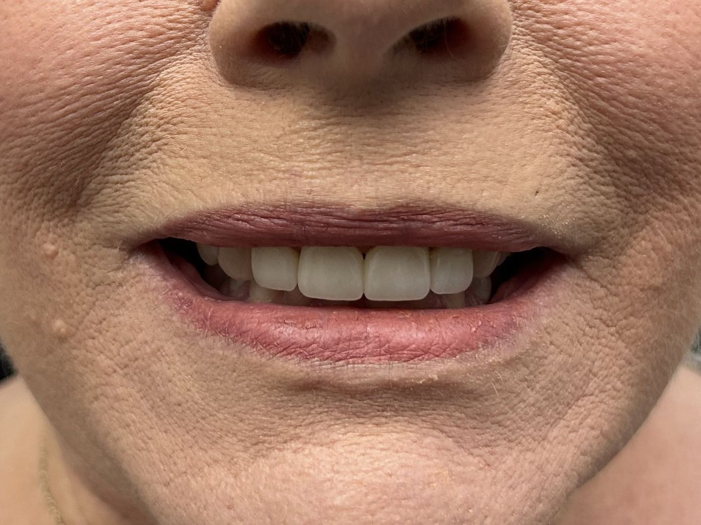 A close up of a woman 's mouth with white teeth.