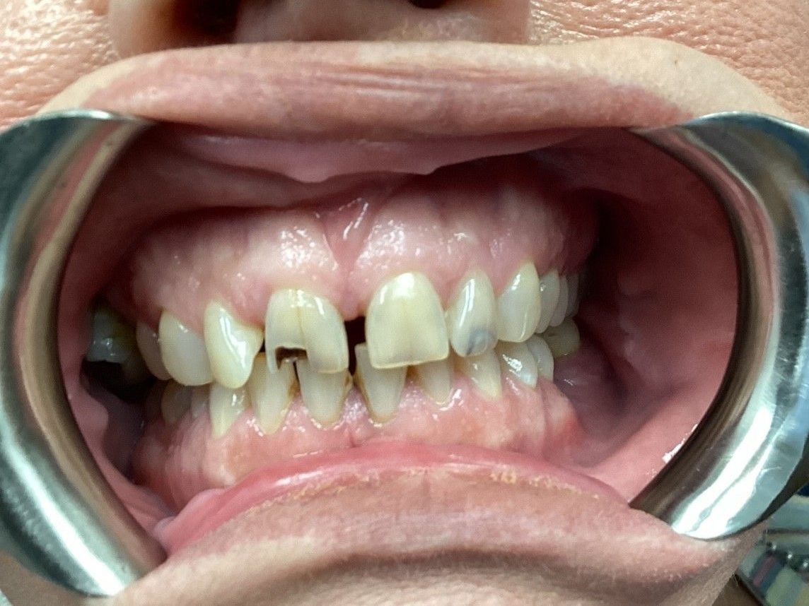 A close up of a person 's mouth with a dental mirror.