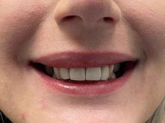 A close up of a woman 's mouth with her teeth showing.