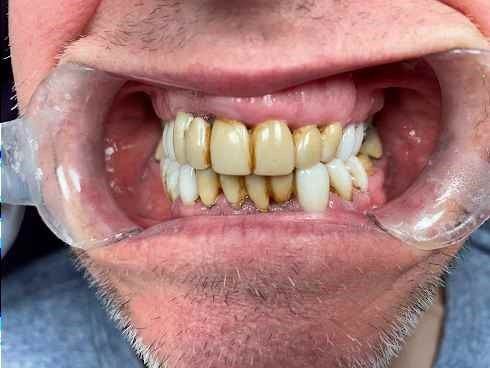 A close up of a man 's mouth with braces on his teeth.