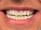 A close up of a man 's smile with white teeth.
