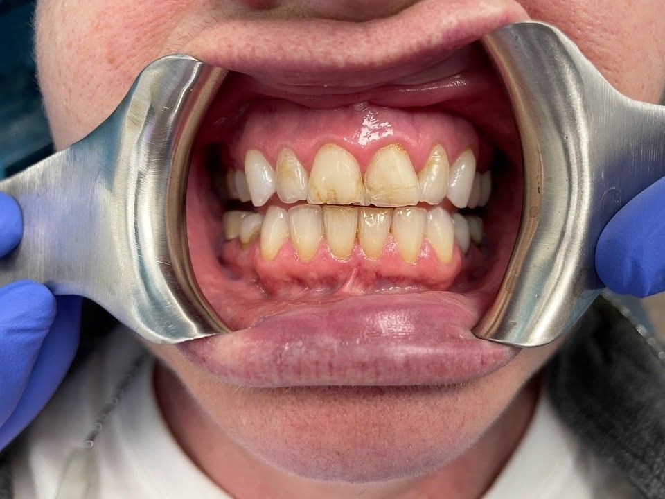 A close up of a person 's mouth with a mouth guard.