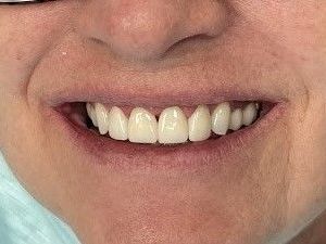 A close up of a woman 's smile with white teeth.