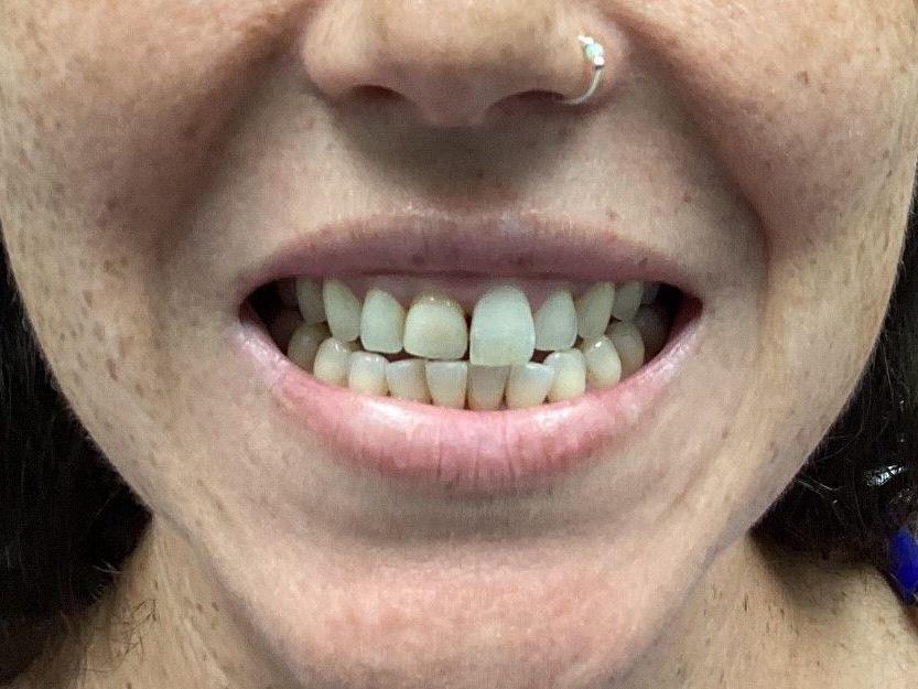 A close up of a woman 's teeth with a nose ring.