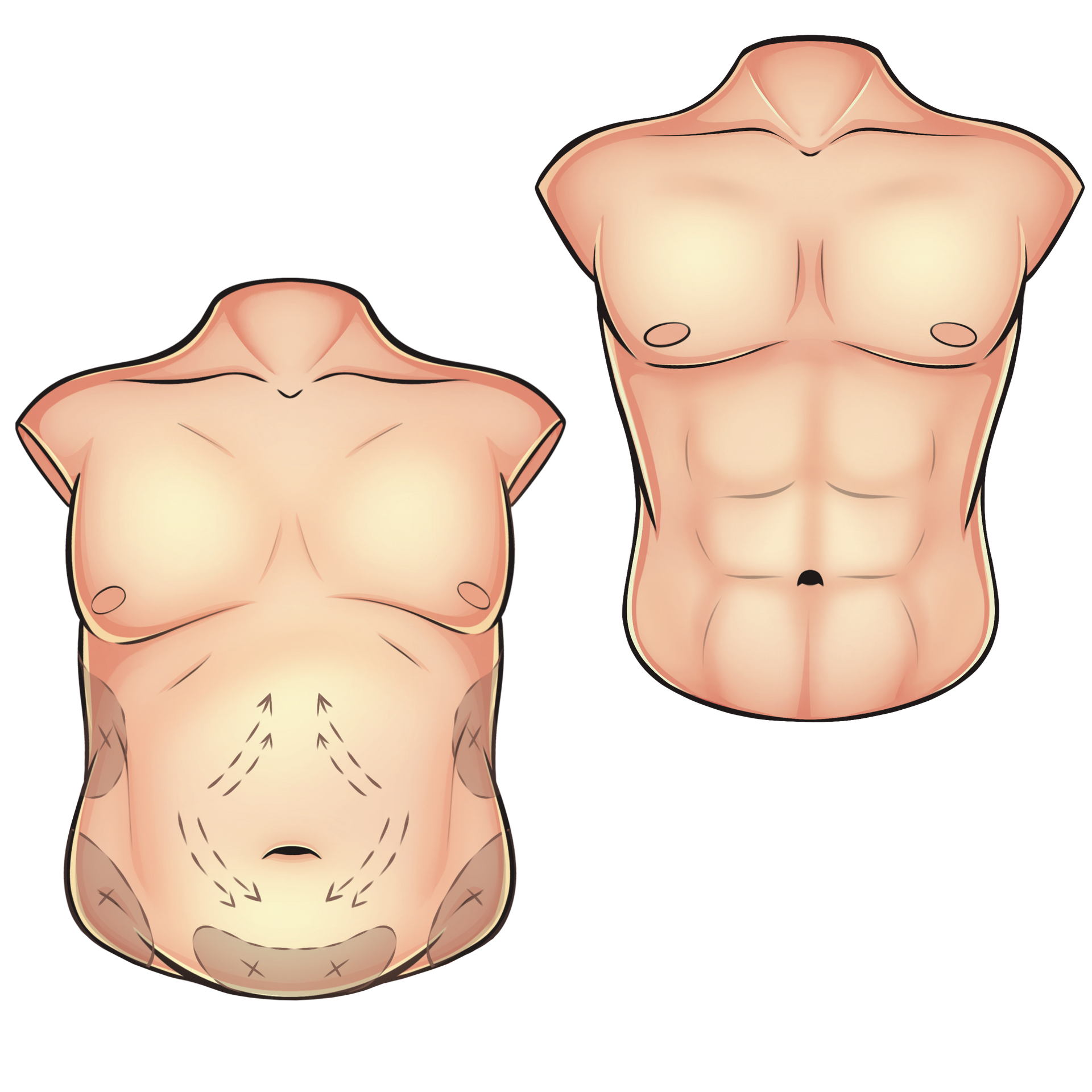 Um desenho do torso de um homem antes e depois da cirurgia