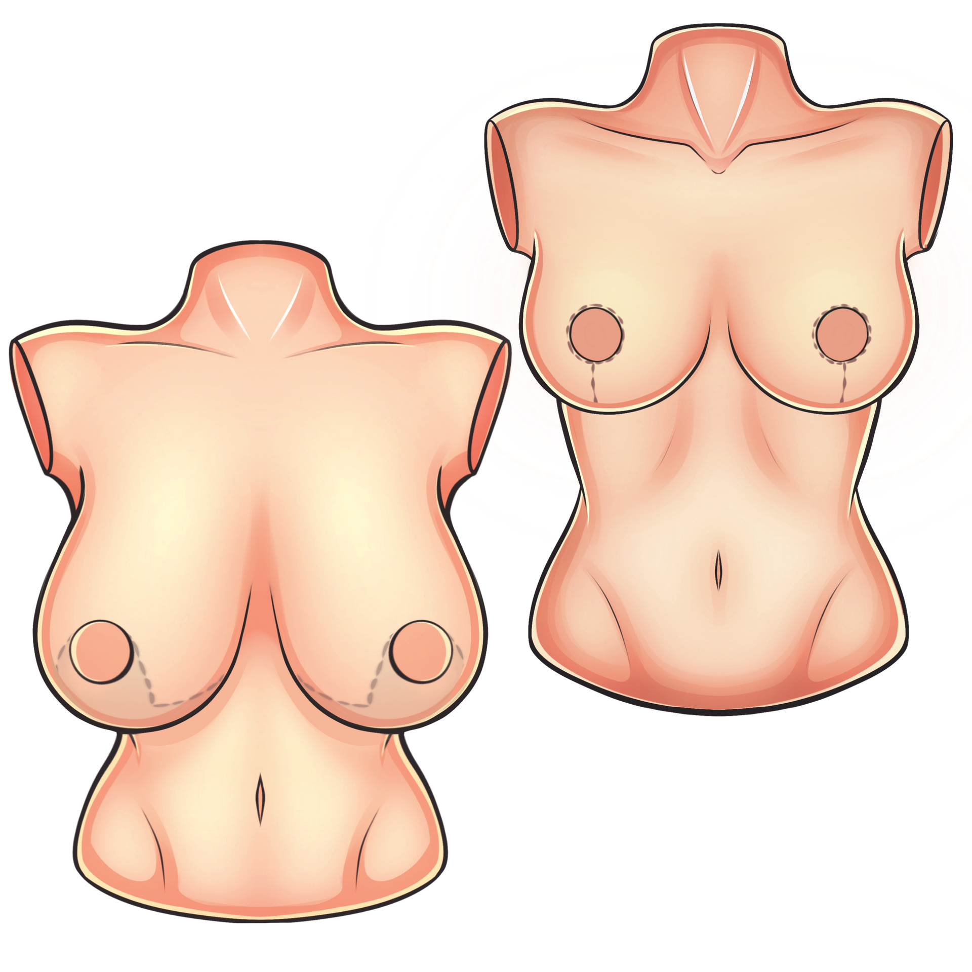 Mamoplastia de redução