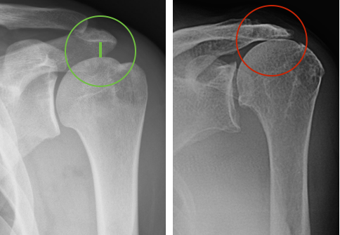 Uma radiografia antes e depois de um ombro com um círculo verde e um círculo vermelho.