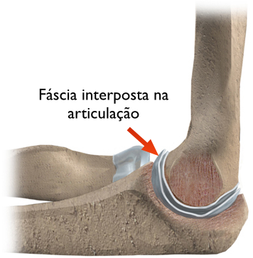 Desenho de cotovelo com fáscia interposta na articulação