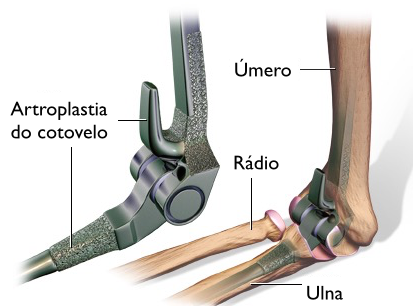 Um diagrama de um cotovelo quebrado com uma radiografia do cotovelo