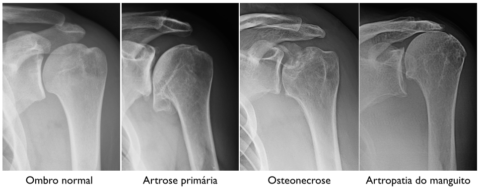 Existem quatro tipos diferentes de radiografias do ombro.