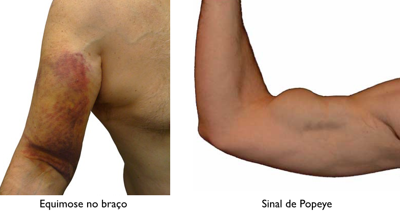 O braço de um homem com hematoma e o braço de um homem sem hematoma