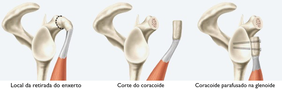 Um diagrama de uma articulação do ombro mostrando diferentes tipos de cirurgia.