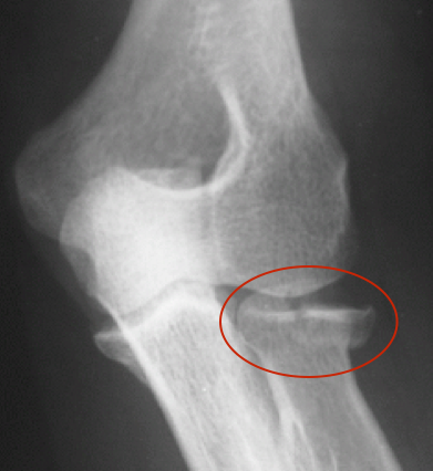 Uma radiografia de um cotovelo com um círculo vermelho ao redor