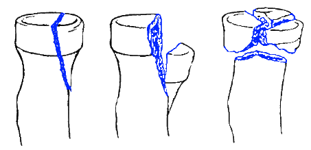 Um desenho de três tipos diferentes de garrafas quebradas.
