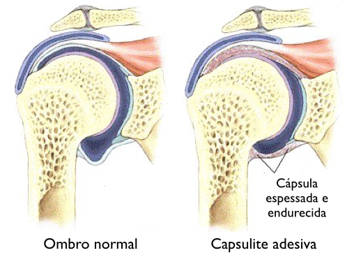 Um diagrama de um ombro normal e um ombro de cápsula adesiva.