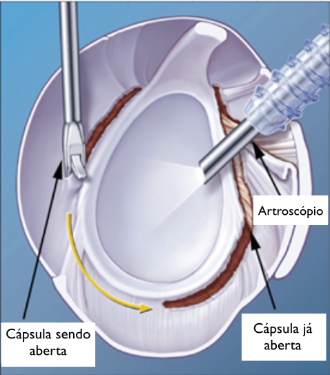 A drawing of a capsule sendo aberta and a capsule ja aberta