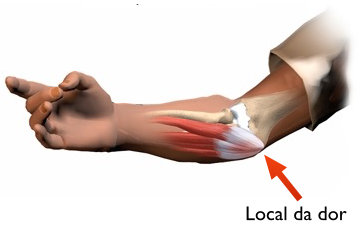 Uma ilustração do cotovelo de uma pessoa com uma seta apontando para o local da dor